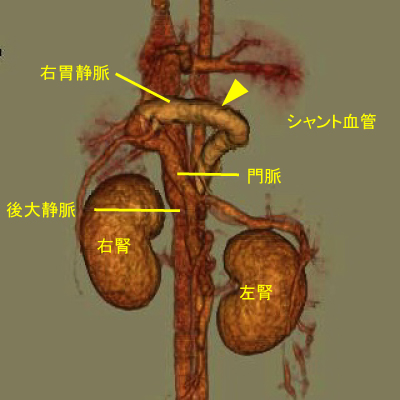 右胃静脈-後大静脈シャント
