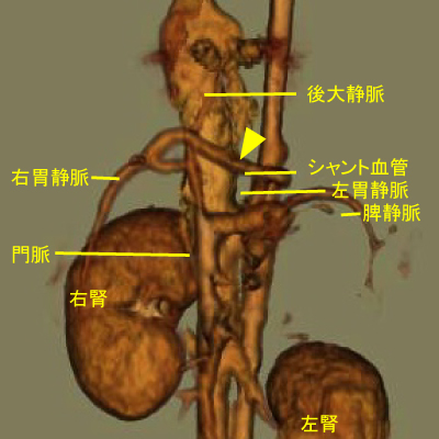 右胃‐左胃‐脾‐後大シャント