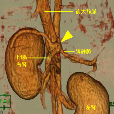 脾静脈-後大静脈シャント（短）