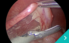 腹腔鏡下避妊（不妊）手術