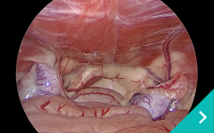 腹腔鏡下潜在精巣摘出術