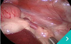 腹腔鏡下門脈体循環シャント手術