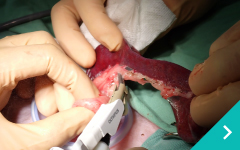 小切開脾臓摘出術