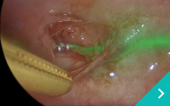 胸腔鏡下乳び胸（Chylothorax）心膜切除手術