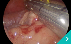 腹腔鏡下膵臓腫瘍摘出術