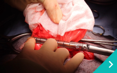 小切開肺葉切除