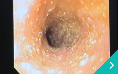 消化器内視鏡検査