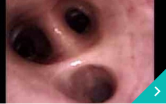 呼吸器内視鏡検査