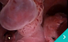 尿道膀胱鏡検査