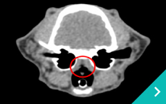 鼻咽頭狭窄拡張術