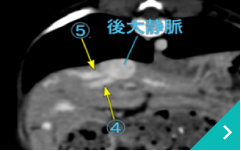 血管プラグ塞栓術
