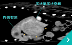 肝臓腫瘤に対する肝動脈塞栓術