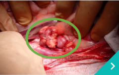 副腎腫瘍摘出術（血管内浸潤）