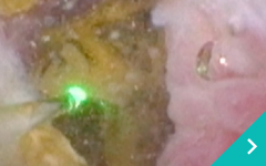 レーザー結石破砕